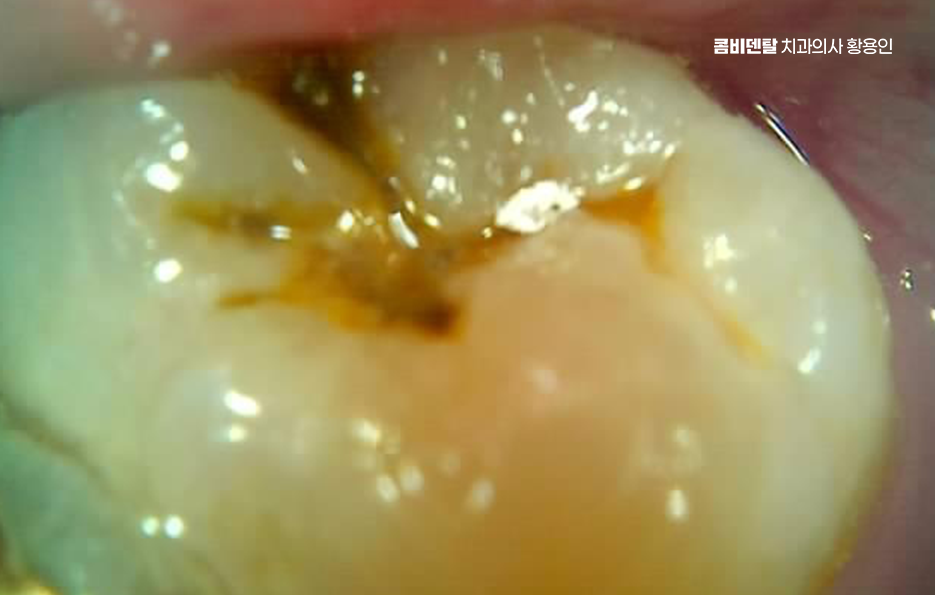 어금니 충치 단계 미리 알아차리려면 관련 이미지 6