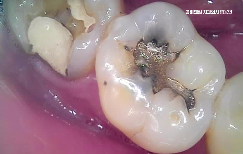 오래된 보철물 아말감 교체 어떠한 케이스일까 관련 이미지 3