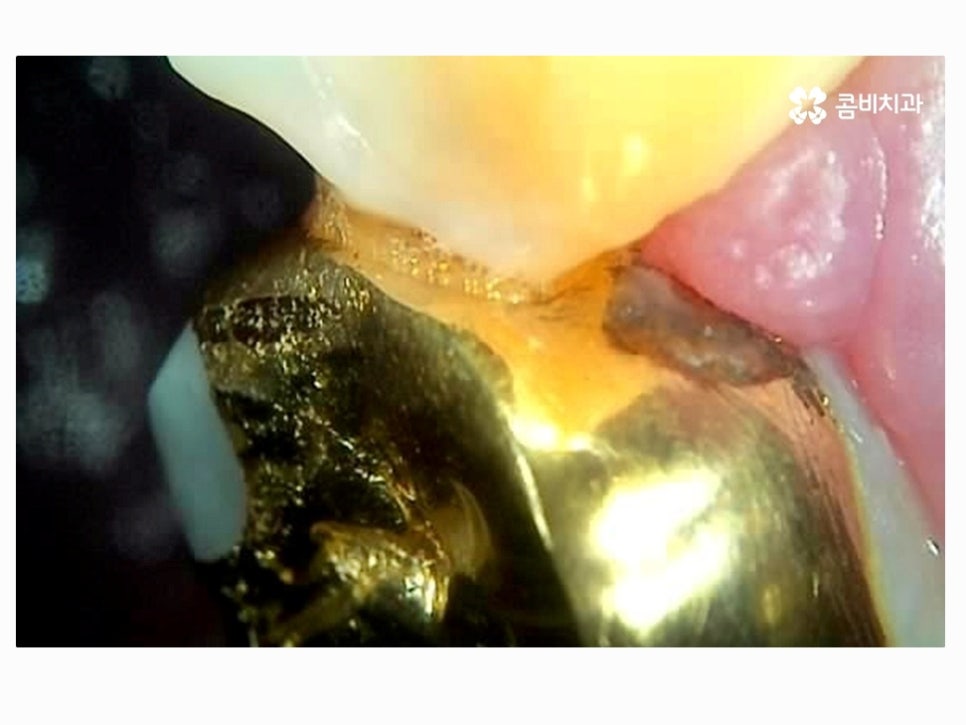 명동치과 누구나 놓치기 쉬운 문제점은! 관련 이미지 7