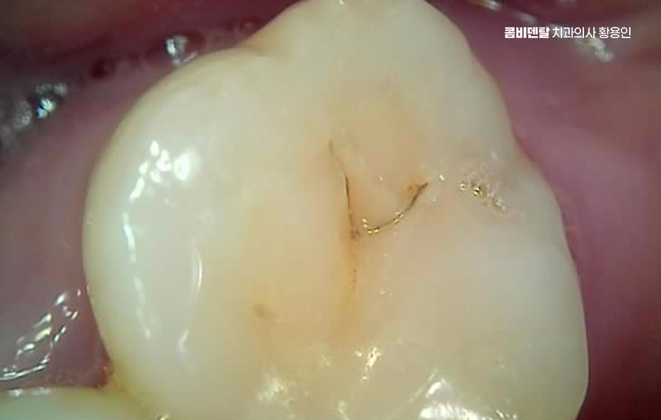 사랑니 주변 잇몸 통증 지금부터가 중요하니까 관련 이미지 6