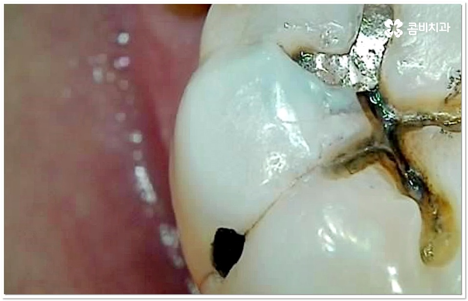 어금니 충치치료 빠를수록 좋아요 관련 이미지 1