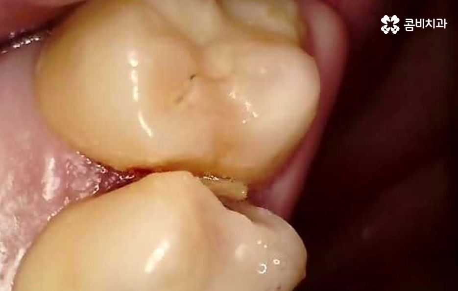 어금니 충치치료 깔끔하게 해결하려면 관련 이미지 6
