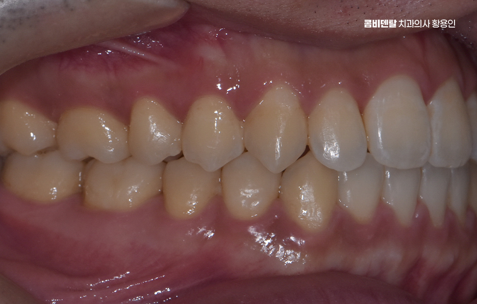 클리피씨교정 장단점 어떻게 비교하면 될까요 관련 이미지 8