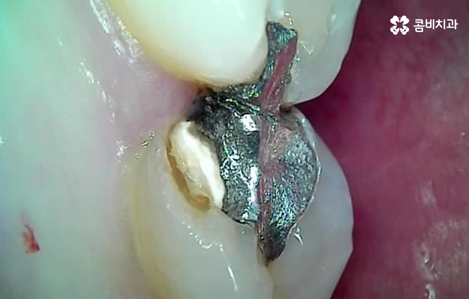 어금니 충치 깨짐 판단기준부터 세워보세요 관련 이미지 13