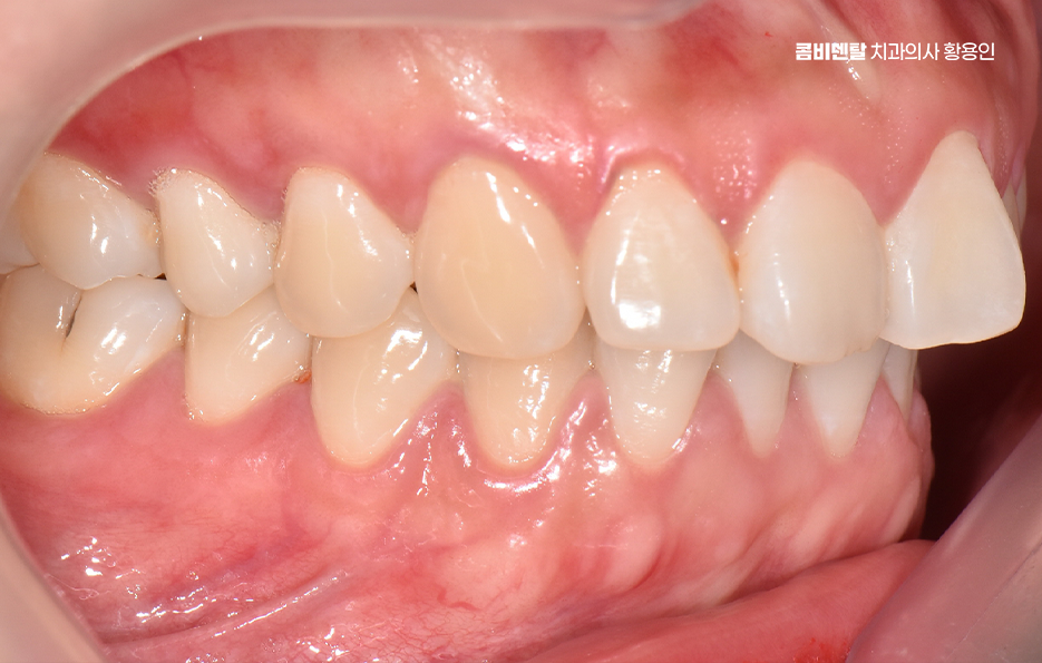 돌출입 팔자주름 교정 얼마나 바뀔까요 관련 이미지 2