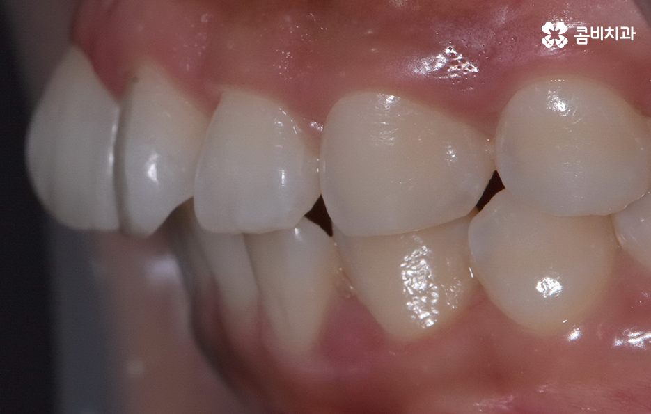 앞니 틀어짐 교정 방법 이럴때는 좀더 간단해요 관련 이미지 4