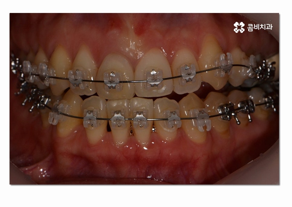 3급 부정교합 지금이라도 고치고 싶다면 관련 이미지 6