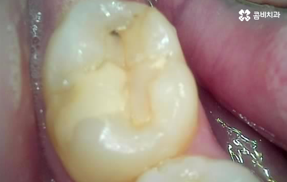 레진 인레이 치료 후 2차충치 왜 발생하고 어떻게 대처할까 관련 이미지 5