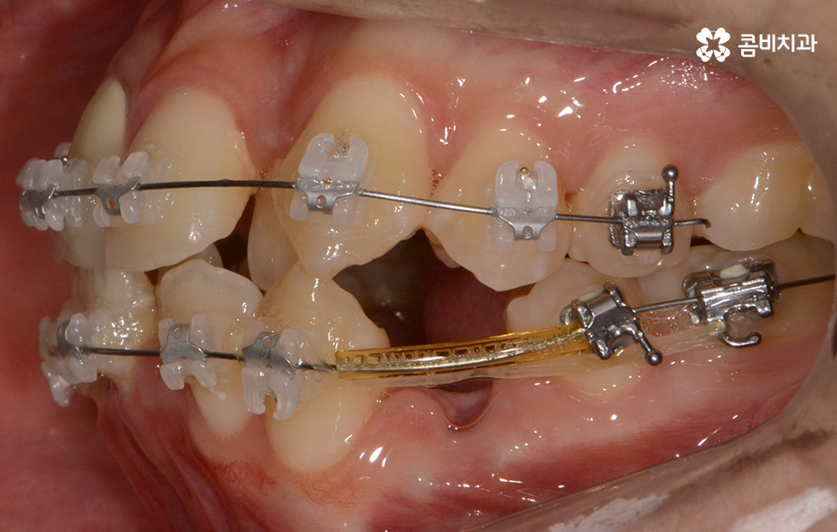덧니교정 불편함이 느껴지지 않더라도 관련 이미지 9
