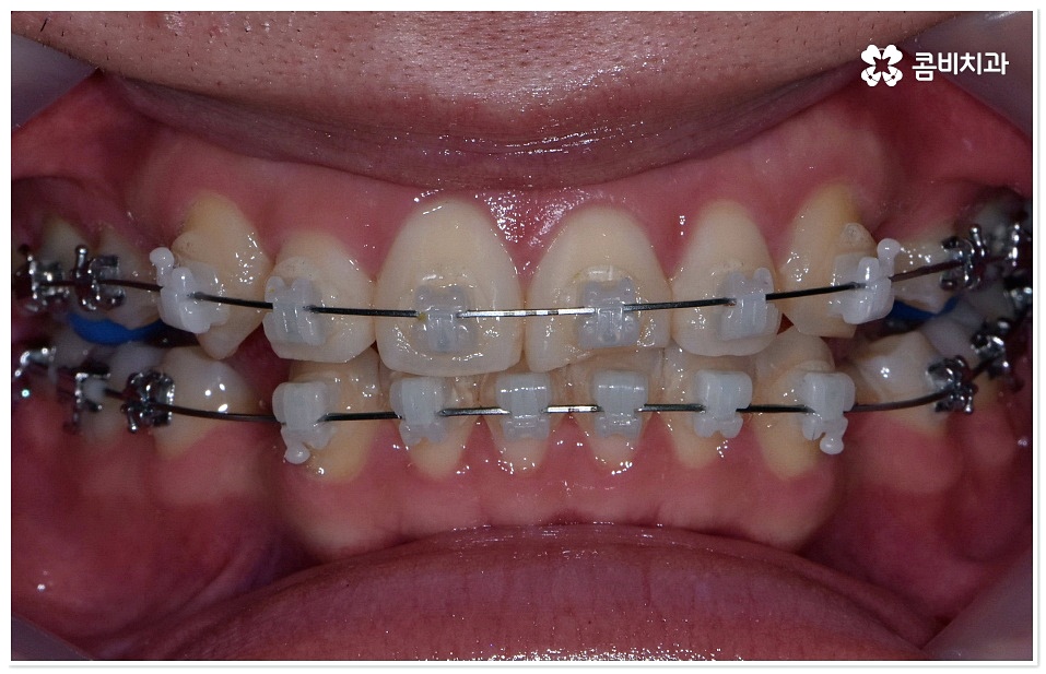덧니치아교정 고려할 사항들은 관련 이미지 3