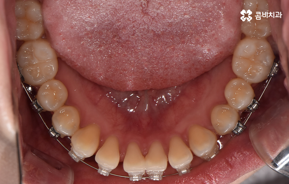 아래앞니 벌어짐 교정으로 해결했어요 관련 이미지 10