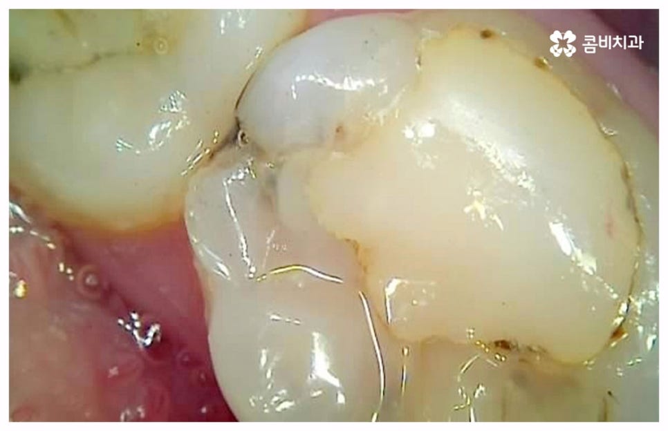 치통이 심할때 어떻게 해야하나요 관련 이미지 8