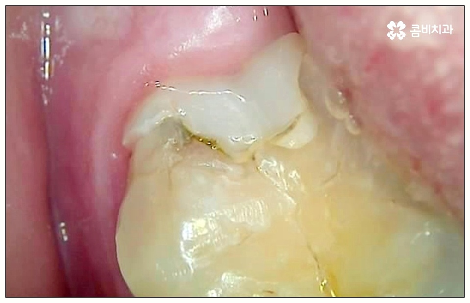 어금니 사이 충치 빠르게 대응해야 관련 이미지 3