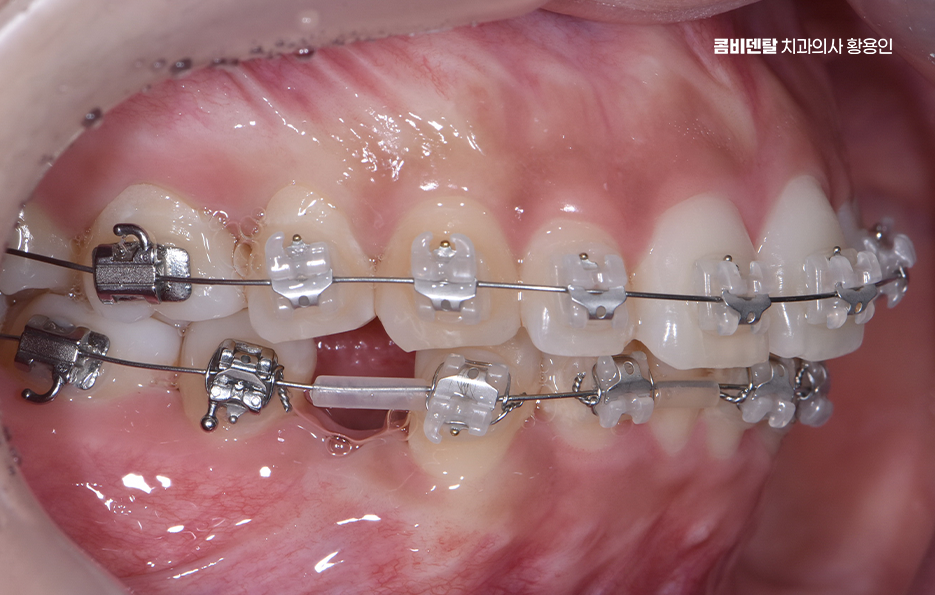 앞니 틀어짐 교정 이렇게 파악하세요 관련 이미지 9