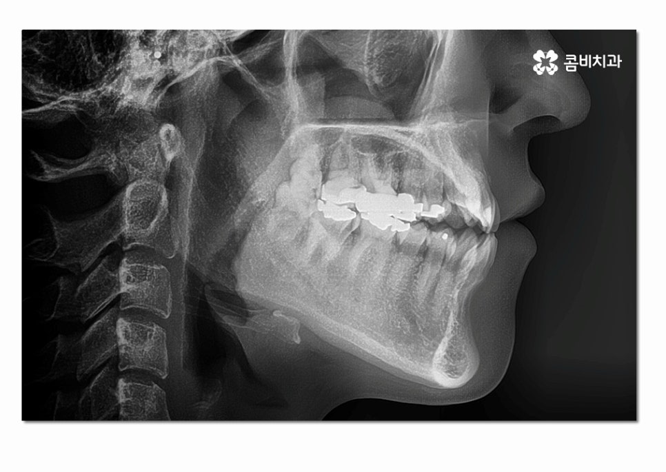 3급 부정교합 지금이라도 고치고 싶다면 관련 이미지 5