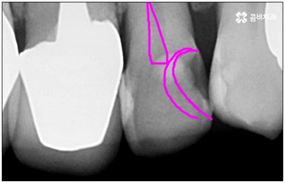 당일임플란트 나도 할수있나요 관련 이미지 11