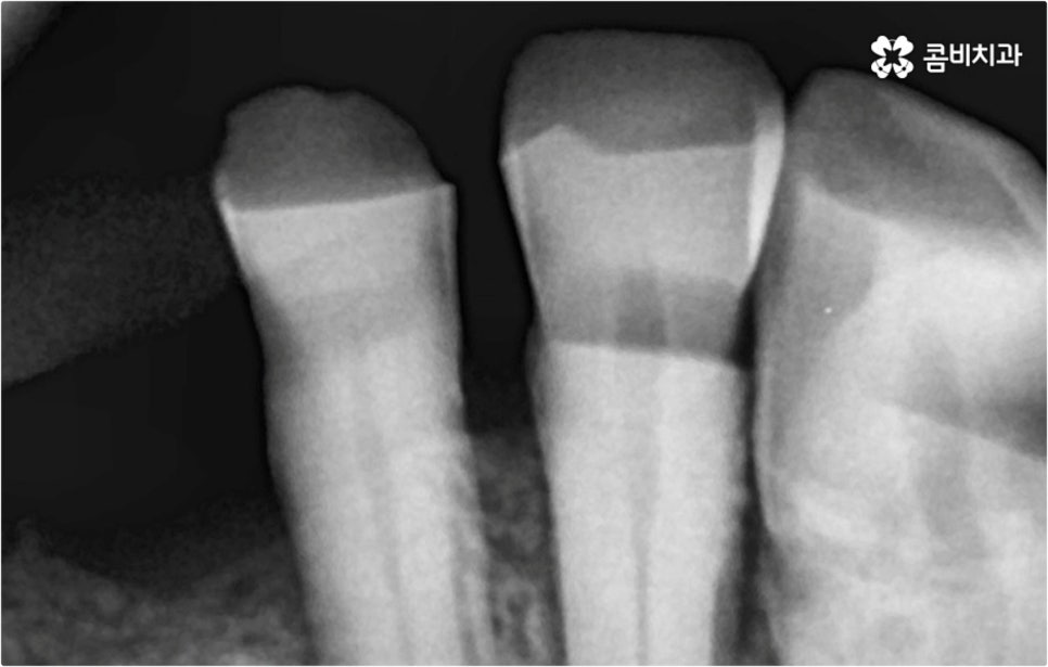 전악임플란트 고려할 사항들은 관련 이미지 6