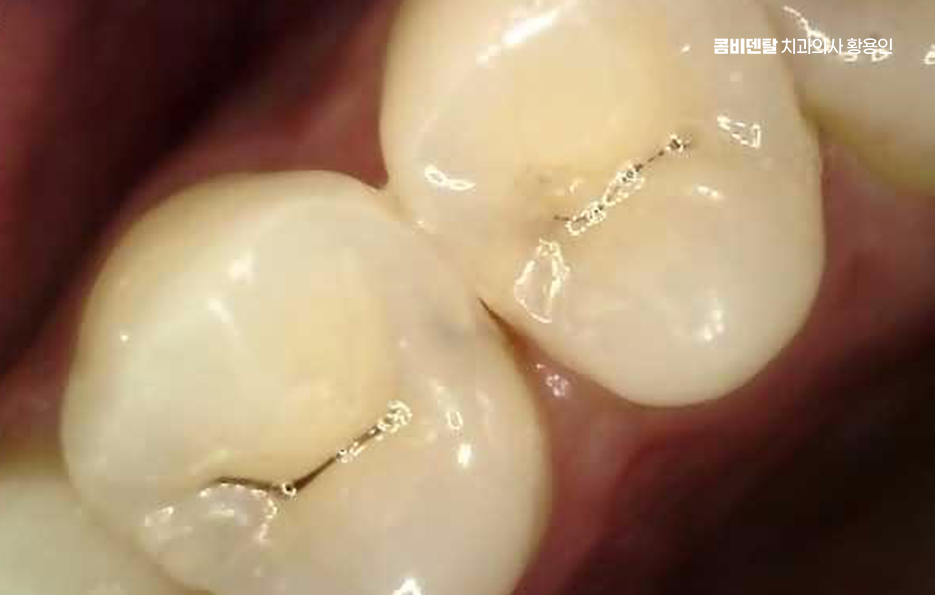 충치 치아 깨짐 시점이 관건이라면 관련 이미지 8