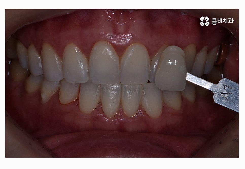 누런이로 고민하시는 분들을 위한 치아미백 정보 관련 이미지 5