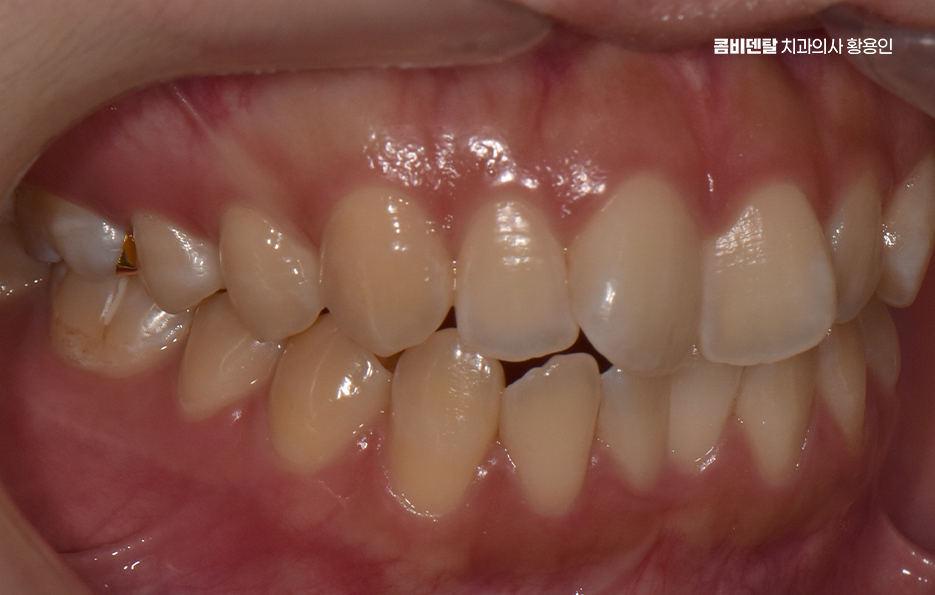 How Can You Determine the Duration of Front Teeth Orthodontic Treatment? image 4