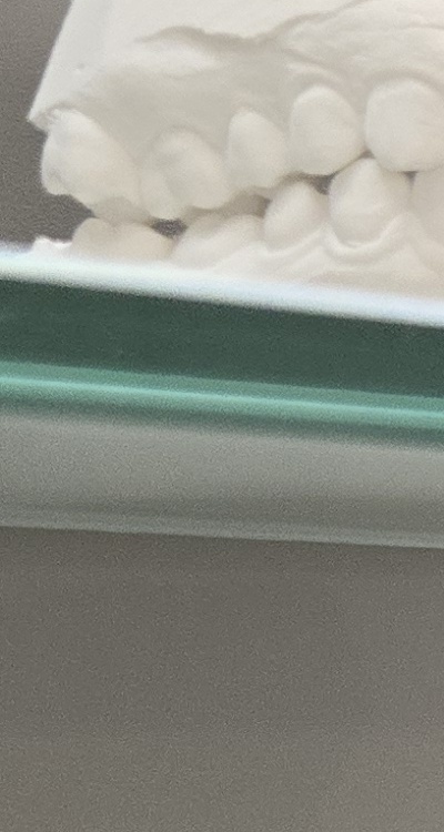 앞니 틀어짐 부분교정 얼마나 걸릴까 관련 이미지 23