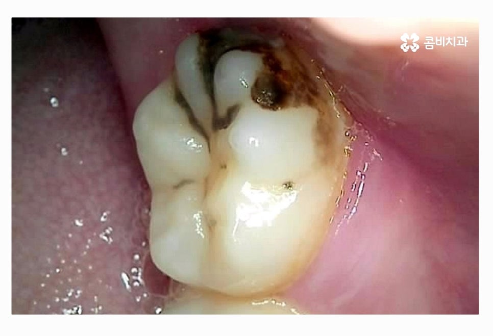 사랑니 충치 현명하게 접근하려면 관련 이미지 7