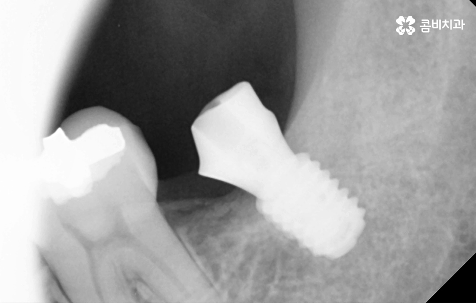 임플란트 치료기간 어느정도 걸리고 치과에는 몇번 가나요 관련 이미지 13