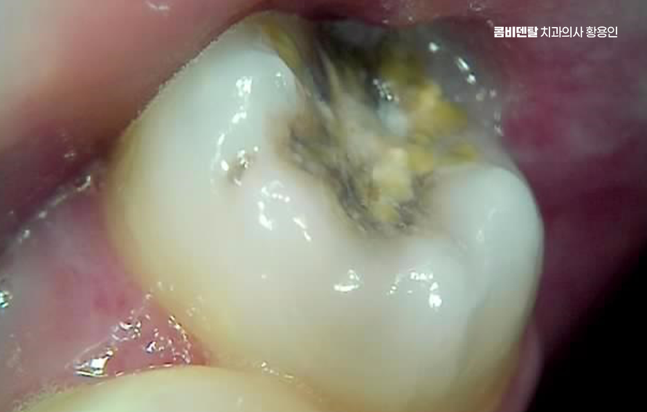 명동치과 흔하게 놓치는 사례를 정리해요 관련 이미지 2
