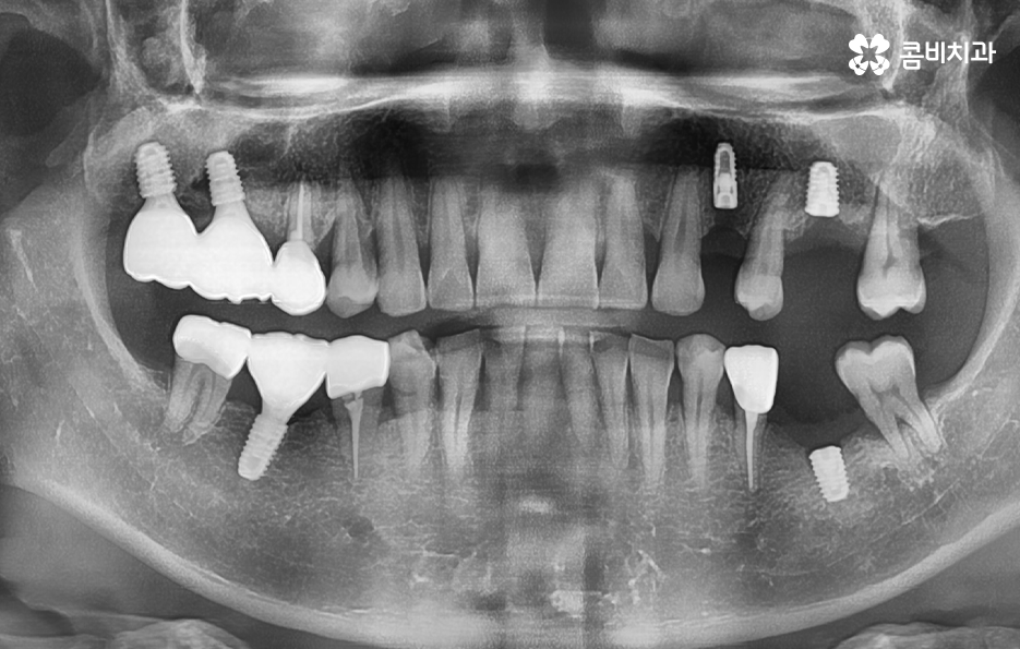 노인임플란트 이때부터 특히 조심하세요 관련 이미지 13
