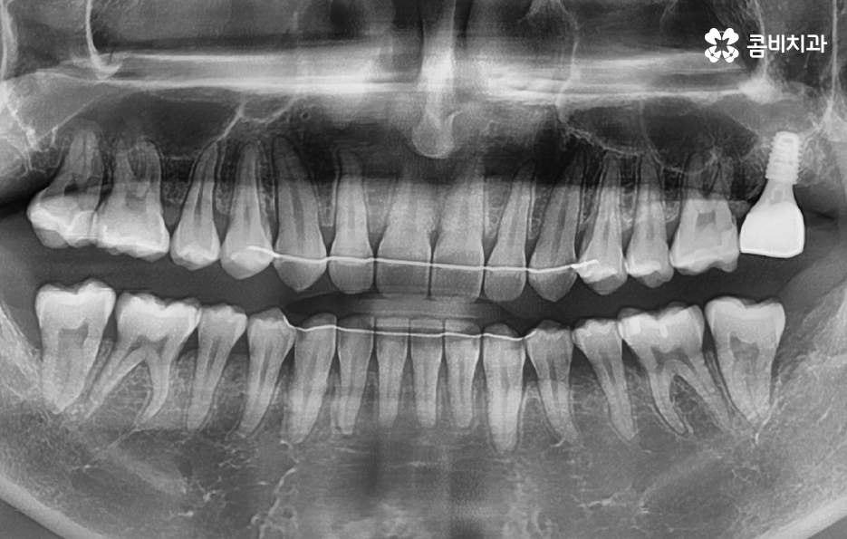 어금니 발치후 임플란트 이런점을 주의합시다 관련 이미지 9