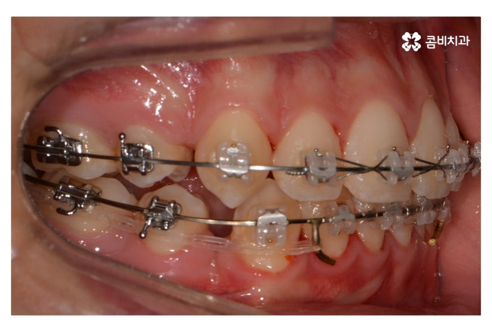 중학생치아교정 세심하게 체크하려면 관련 이미지 9