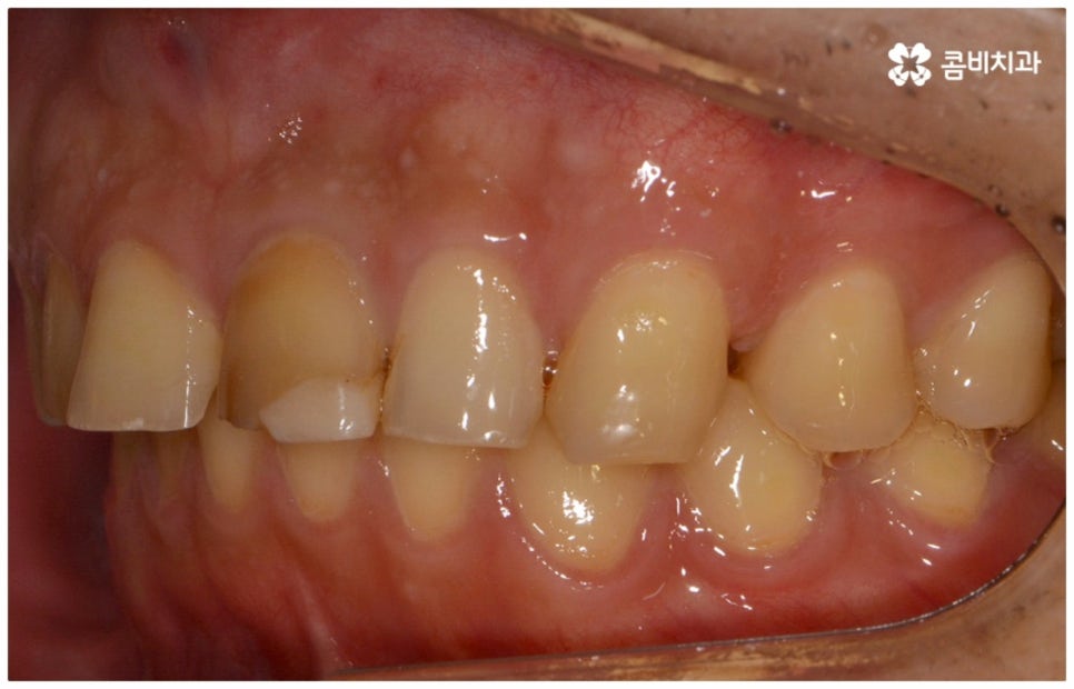 앞니충치치료 어떻게 이뤄지나요 관련 이미지 3