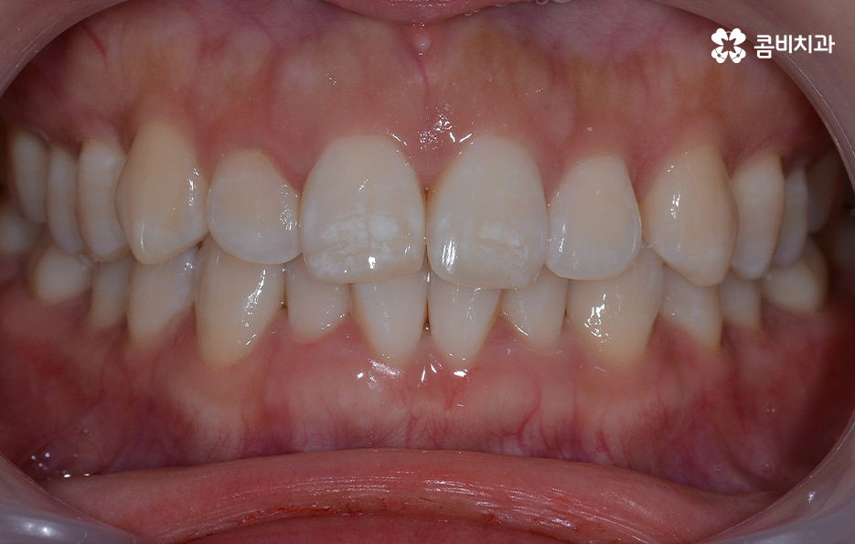 비발치치아교정 고민되는데 발치하면 안좋나요 관련 이미지 3