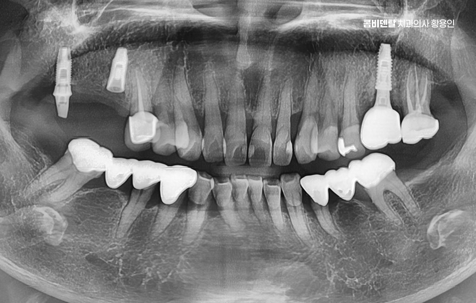 치아 사이 벌어짐 심해지는 이유부터 알아보면 관련 이미지 1