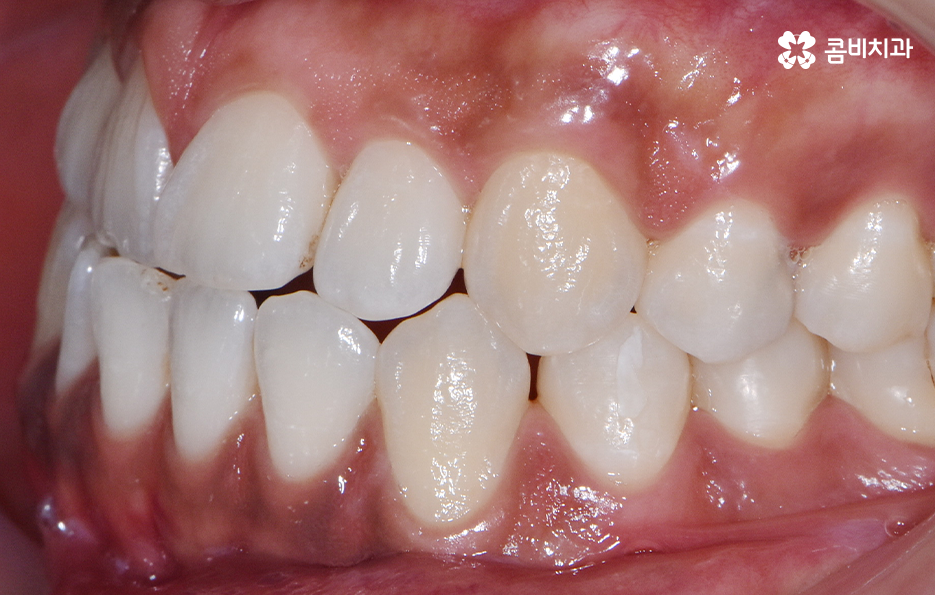 성인 부정교합 교정 더는 미루고 싶지 않다면 관련 이미지 3