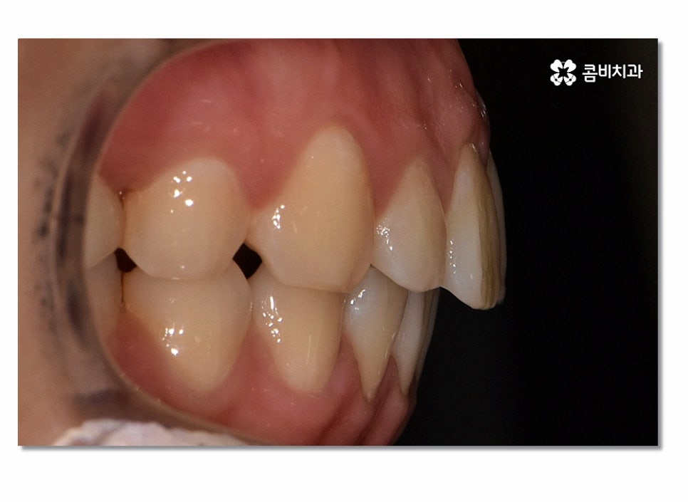 돌출입치아교정 부담이 크게 느껴진다면 관련 이미지 13