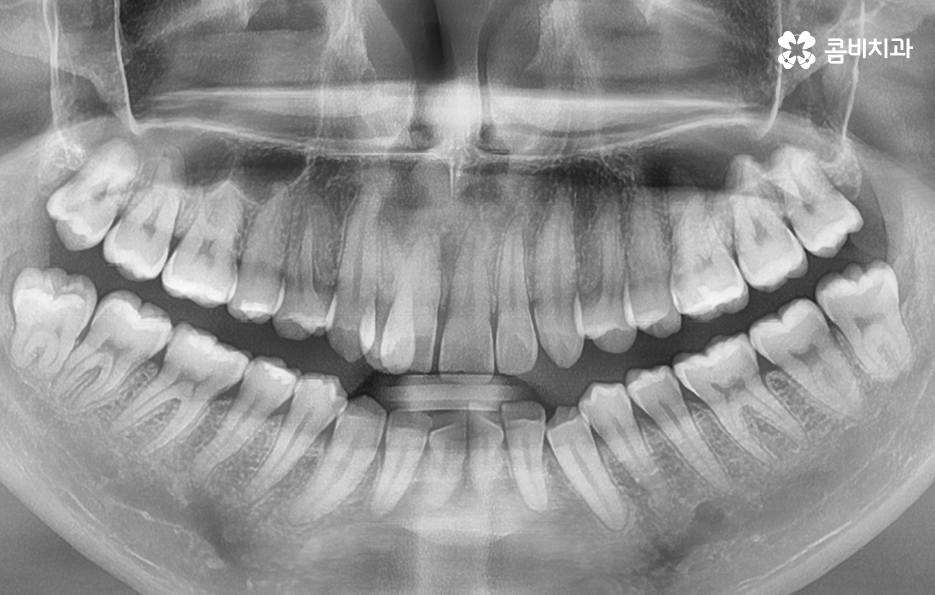덧니 발치교정으로 교정할 때 치아가 이렇게 이동해요 관련 이미지 7