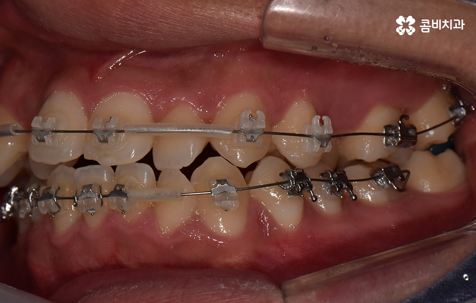 30대 치아교정 빨리 끝내고 싶어요 관련 이미지 8