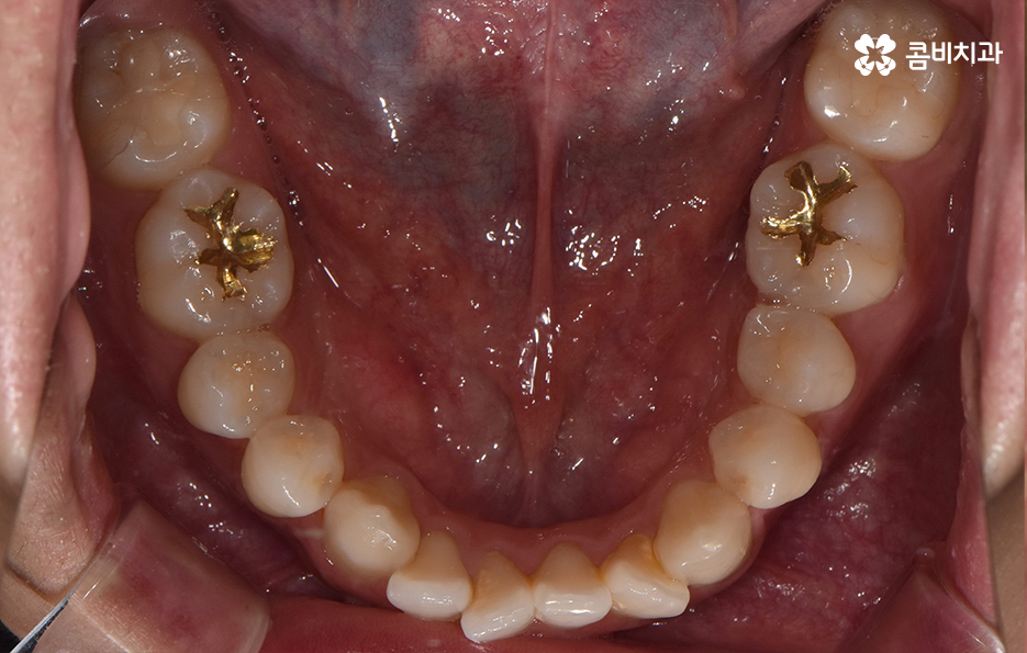 30대 치아교정 빨리 끝내고 싶어요 관련 이미지 5