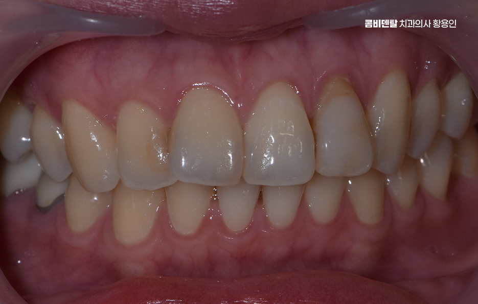 앞니 틀어짐 부분교정 얼마나 걸릴까 관련 이미지 1