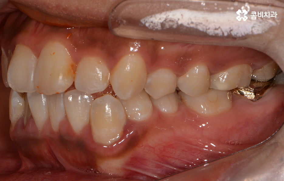 클리피씨교정 알아볼 때 꼭 신경 써야 하는 점은! 관련 이미지 3