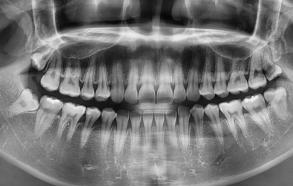 사랑니발치통증 이렇게 해야 쉬워져요 관련 이미지 6