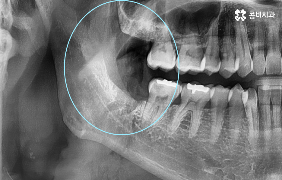 매복사랑니 냄새 방치하면 이런 문제도 생겨요 관련 이미지 4
