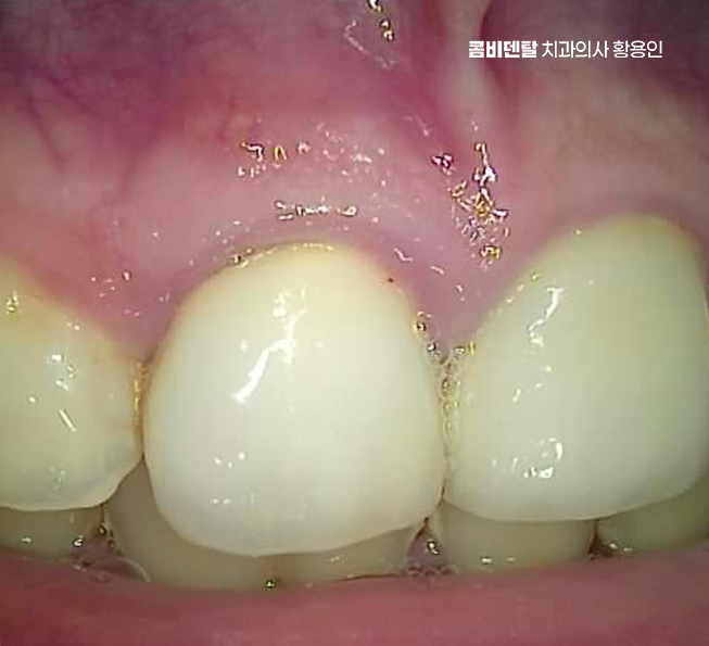 앞니 신경치료 크라운 까지 해야할 상황이라면 관련 이미지 2