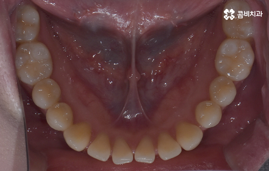 아래앞니 벌어짐 교정으로 해결했어요 관련 이미지 6