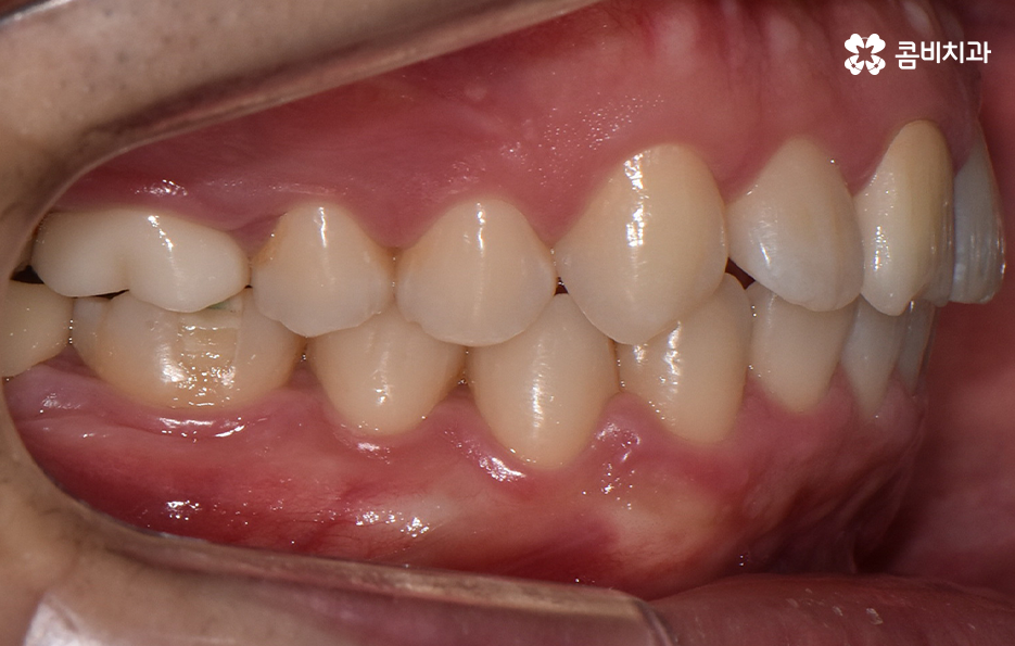 아랫니교정 이렇게만 파악하시면 됩니다 관련 이미지 13