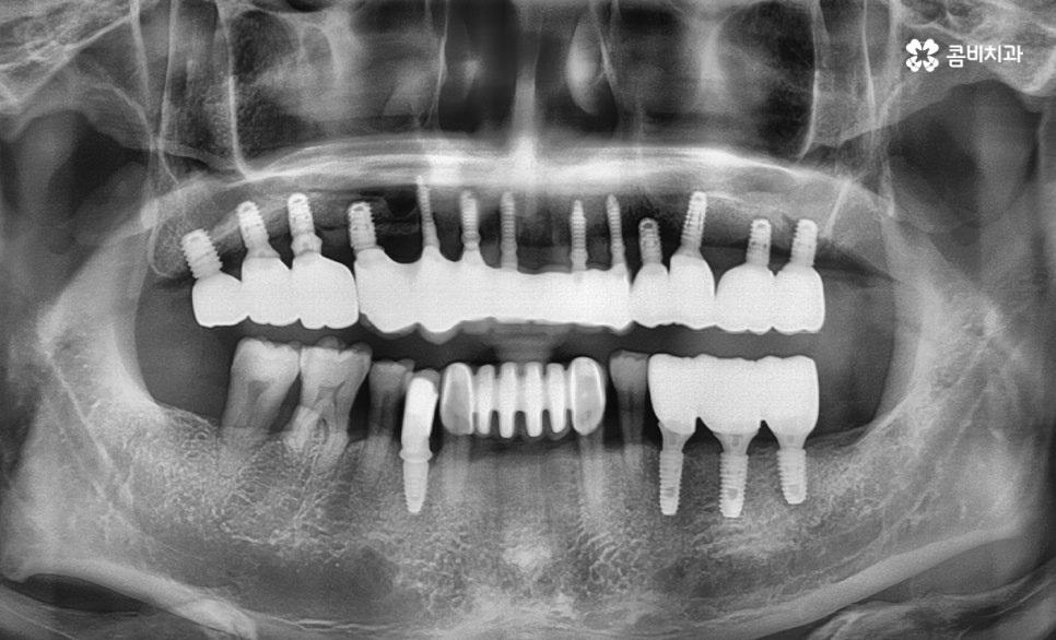 임플란트 수술 여전히 결코 간단하게 볼 수 없는 이유 관련 이미지 5