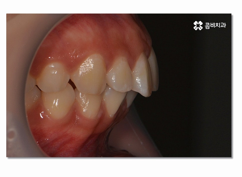 돌출입치아교정 부담이 크게 느껴진다면 관련 이미지 1