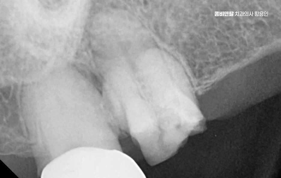 어금니 임플란트 안하면 후회하게 되는걸까 관련 이미지 7