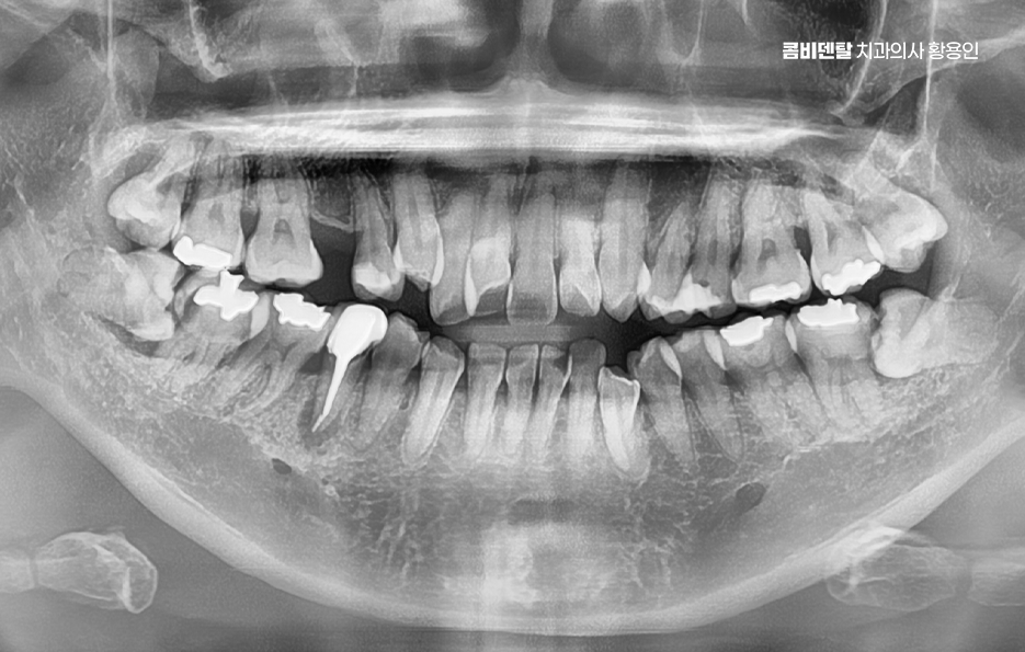 앞니 틀어짐 교정 조화롭게 마무리하려면 관련 이미지 7